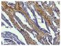 Paraffin embedded human gastric cancer tissue was stained with Goat Anti-Type I Collagen-BIOT (SB Cat. No. 1310-08) followed by Streptavidin-HRP (SB Cat. No. 7100-05), DAB, and hematoxylin.