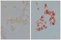 Human pancreatic carcinoma cell line MIA PaCa-2 was stained with Mouse Anti-Human EGFR-UNLB (SB Cat. No. 10400-01; right) followed by Goat Anti-Mouse IgG<sub>2a</sub>, Human ads-AP (SB Cat. No. 1080-04), Red AP, and mounted with Fluoromount-G<sup>®</sup> (SB Cat. No. 0100-01).