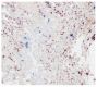 Frozen human lung tissue section was stained with anti-DC-SIGN followed by an AP conjugated secondary antibody and New Fucshin. The section was then stained with anti-CD207 followed by Goat Anti-Mouse IgG<sub>1</sub>, Human ads-BIOT (SB Cat. No. 1070-08), AP conjugated streptavidin, and Blue AP.<br/>Image from Van Pottelberge GR, Bracke KR, Demedts IK, De Rijck K, Reinartz SM, van Drunen CM, et al. Selective accumulation of langerhans-type dendritic cells in small airways of patients with COPD. Respir Res. 2010;11:35. Figure 2(a)<br/>Reproduced under the Creative Commons license https://creativecommons.org/licenses/by/2.0/