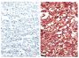 Paraffin embedded AIDS-associated Burkitt lymphoma tissue array was stained with anti-CXCR5 (right) and Rat IgG<sub>2b</sub>-UNLB (SB Cat. No. 0118-01; left) followed by a secondary antibody and Fast Red.<br/>Images from Widney DP, Gui D, Popoviciu LM, Said JW, Breen EC, Huang X, et al. Expression and function of the chemokine, CXCL13, and its receptor, CXCR5, in AIDS-associated non-Hodgkin's lymphoma. AIDS Research and Treatment. 2010;2010:164586. Figure 2(a)<br/>Reproduced under the Creative Commons license https://creativecommons.org/licenses/by/3.0/