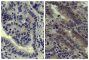 Paraffin embedded human gastric cancer tissue was stained with Mouse IgG-UNLB isotype control (SB Cat. No. 0107-01; left) and Mouse Anti-Human EGFR-UNLB (SB Cat. No. 10400-01; right) followed by an HRP conjugated anti-mouse IgG secondary antibody, DAB, and hematoxylin.