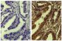 Paraffin embedded human gastric cancer tissue was stained with Mouse Anti-Human TIMP-4-UNLB (SB. Cat. No. 12035-01; right) followed by followed by HRP conjugated Anti-Mouse Ig secondary antibody, DAB, and hematoxylin.