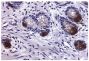 Paraffin embedded human colon cancer tissue was stained with Mouse Anti-Human MMP-9-UNLB (SB Cat. No. 12025-01) followed by Goat Anti-Mouse IgG<sub>2a</sub>, Human ads-BIOT (SB Cat. No. 1080-08), Streptavidin-HRP (SB Cat. No. 7100-05), DAB, and hematoxylin.