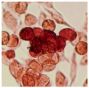 HEK-293A cells infected with B438L recombinant adenovirus were stained with gamma-irradiated African swine fever virus-specific convalescent serum followed by Goat Anti-Porcine IgG(H+L)-FITC (SB Cat. No. 6050-04) and developed with Fast Red.<br/>Image from Lokhandwala S, Waghela SD, Bray J, Sangewar N, Charendoff C, Martin CL, et al. Adenovirus-vectored novel African Swine Fever Virus antigens elicit robust immune responses in swine. PLoS One. 2017;12(5):e0177007. Figure 1(b)<br/>Reproduced under the Creative Commons license https://creativecommons.org/publicdomain/zero/1.0/