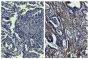 Paraffin embedded human gastric cancer tissue was stained with Mouse IgG<sub>1</sub>-UNLB isotype control (SB Cat. No. 0102-01; left) and Mouse Anti-Human MMP-2-UNLB (SB Cat. No. 12015-01; right) followed by HRP conjugated Anti-Mouse Ig secondary antibody, DAB, and hematoxylin.