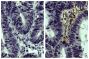 Paraffin embedded human gastric cancer tissue was stained with Goat IgG-UNLB isotype control (SB Cat. No. 0109-01; left) and Goat Anti-Type III Collagen-UNLB (SB Cat. No. 1330-01; right) followed by Swine Anti-Goat IgG(H+L), Human/Rat/Mouse SP ads-HRP (SB Cat. No. 6300-05), DAB, and hematoxylin.