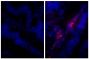 Paraffin embedded human gastric cancer tissue was stained with Rabbit IgG-UNLB isotype control (SB Cat. No. 0111-01; left) and Rabbit Anti-Human IgG(H+L), Mouse ads-UNLB (SB Cat. No. 6145-01; right) followed by Donkey Anti-Rabbit IgG(H+L), Mouse/Rat/Human SP ads-AF555 (SB Cat. No. 6440-32) and DAPI.