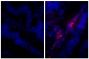 Paraffin embedded human gastric cancer tissue was stained with Rabbit IgG-UNLB isotype control (SB Cat. No. 0111-01; left) and Rabbit Anti-Human IgG(H+L), Mouse ads-UNLB (SB Cat. No. 6145-01; right) followed by Donkey Anti-Rabbit IgG(H+L), Mouse/Rat/Human SP ads-AF555 (SB Cat. No. 6440-32) and DAPI.