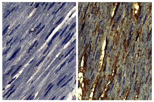 Paraffin embedded human gastric cancer tissue was stained with Goat IgG-UNLB isotype control (SB Cat. No. 0109-01; left) and Goat Anti-Type VI Collagen-UNLB (SB Cat. No. 1360-01; right) followed by Swine Anti-Goat IgG(H+L), Human/Rat/Mouse SP ads-BIOT (SB Cat. No. 6300-08), Streptavidin-HRP (SB Cat. No. 7100-05), DAB, and hematoxylin.