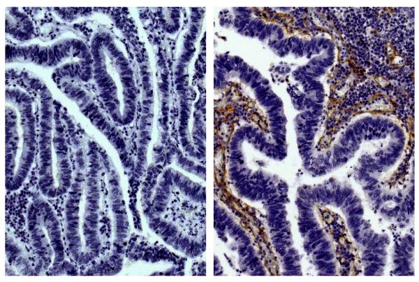 Paraffin embedded human gastric cancer tissue was stained with Goat IgG-UNLB isotype control (SB Cat. No. 0109-01; left) and Goat Anti-Type IV Collagen-UNLB (SB Cat. No. 1340-01; right) followed by Swine Anti-Goat IgG(H+L), Human/Rat/Mouse SP ads-HRP (SB Cat. No. 6300-05), DAB, and hematoxylin.