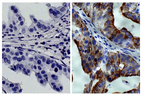 Paraffin embedded human gastric cancer tissue was stained with Mouse IgG<sub>2a</sub>-HRP isotype control (SB Cat. No. 0103-05; left) and Mouse Anti-Cytokeratin 8-HRP (SB Cat. No. 10080-05; right) followed by DAB and hematoxylin.