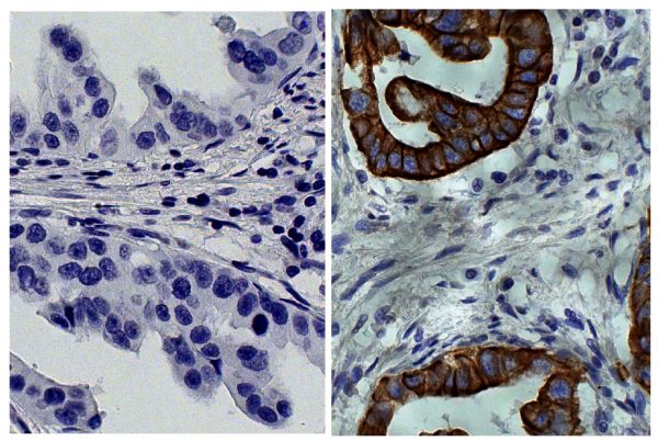 Paraffin embedded human gastric cancer tissue was stained with Mouse IgG<sub>2a</sub>-HRP isotype control (SB Cat. No. 0103-05; left) and Mouse Anti-Cytokeratin 19-HRP (SB Cat. No. 10090-05; right) followed by DAB and hematoxylin.