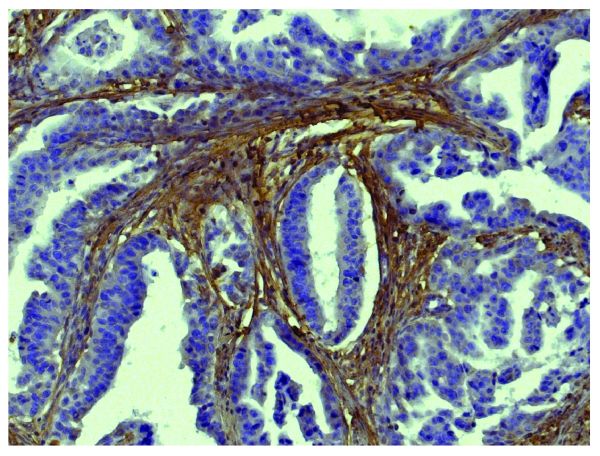 Paraffin embedded human gastric cancer tissue was stained with Goat Anti-Type I Collagen-BIOT (SB Cat. No. 1310-08) followed by Streptavidin-HRP (SB Cat. No. 7100-05), DAB, and hematoxylin.