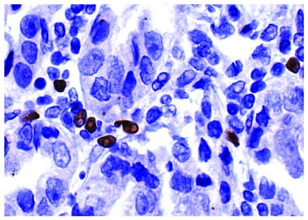 Paraffin embedded human gastric cancer tissue was stained with Mouse Anti-Human Foxp3-UNLB (SB Cat. No. 12200-01) followed by HRP conjugated Anti-Mouse Ig secondary antibody, DAB, and hematoxylin.