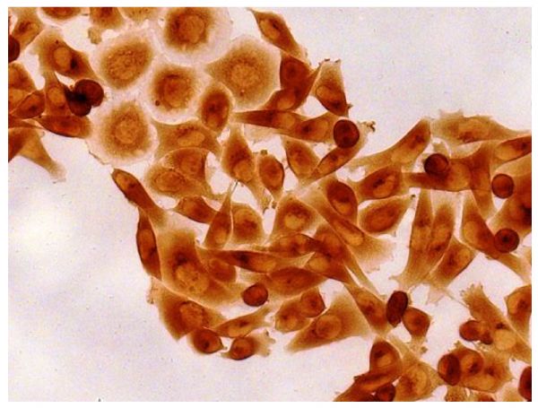 Human pancreatic carcinoma cell line MIA PaCa-2 was stained with Mouse Anti-Human MMP-1-UNLB (SB Cat. No. 12011-01) followed by Goat Anti-Mouse IgG<sub>2b</sub>, Human ads-HRP (SB Cat. No. 1090-05), DAB, and mounted with Fluoromount-G<sup>®</sup> (SB Cat. No. 0100-01).