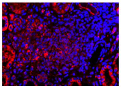 Paraffin embedded human kidney section from AAV patient was stained with anti-C5L2 followed by Goat Anti-Rabbit IgG(H+L), Mouse/Human ads-TRITC (SB Cat. No. 4050-03) and DAPI.<br/>Image from Yuan J, Gou S, Huang J, Hao J, Chen M, Zhao M. C5a and its receptors in human anti-neutrophil cytoplasmic antibody (ANCA)-associated vasculitis. Arthritis Res Ther. 2012;14:R140. Figure 3(c)<br/>Reproduced under the Creative Commons license https://creativecommons.org/licenses/by/2.0/
