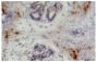 Frozen chicken ovarian tumor section was stained with Mouse Anti-Chicken CD4-UNLB (SB Cat. No. 8210-01) followed by an HRP conjugated secondary antibody, DAB, and hematoxylin.<br/>Image from Bradaric MJ, Barua A, Penumatsa K, Yi Y, Edassery SL, Sharma S, et al. Sphingosine-1 phosphate receptor (S1p1), a critical receptor controlling human lymphocyte trafficking, is expressed in hen and human ovaries and ovarian tumors. J Ovarian Res. 2011;4:4. Figure 7(b)<br/>Reproduced under the Creative Commons license https://creativecommons.org/licenses/by/2.0/