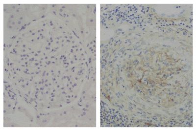 Paraffin embedded glomerular basement membrane tissue sections from patients with Anti-GBM disease were stained with Mouse Anti-Human IgG<sub>2</sub> Fd-UNLB (SB Cat. No. 9080-01; right) followed by an HRP conjugated secondary antibody and DAB.<br/>Images from Qu Z, Cui Z, Liu G, Zhao M. The distribution of IgG subclass deposition on renal tissues from patients with anti-glomerular basement membrane disease. BMC Immunol. 2013;14:19. Figures 1(b,e)<br/>Reproduced under the Creative Commons license https://creativecommons.org/licenses/by/2.0/