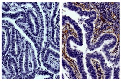 Paraffin embedded human gastric cancer tissue was stained with Goat IgG-UNLB isotype control (SB Cat. No. 0109-01; left) and Goat Anti-Type IV Collagen-UNLB (SB Cat. No. 1340-01; right) followed by Swine Anti-Goat IgG(H+L), Human/Rat/Mouse SP ads-HRP (SB Cat. No. 6300-05), DAB, and hematoxylin.