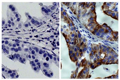 Paraffin embedded human gastric cancer tissue was stained with Mouse IgG<sub>2a</sub>-HRP isotype control (SB Cat. No. 0103-05; left) and Mouse Anti-Cytokeratin 8-HRP (SB Cat. No. 10080-05; right) followed by DAB and hematoxylin.