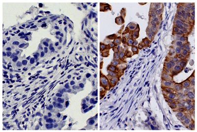 Paraffin embedded human gastric cancer tissue was stained with Mouse IgG<sub>2b</sub>-HRP isotype control (SB Cat. No. 0104-05; left) and Mouse Anti-Cytokeratin 18-HRP (SB Cat. No. 10085-05; right) followed by DAB and hematoxylin.