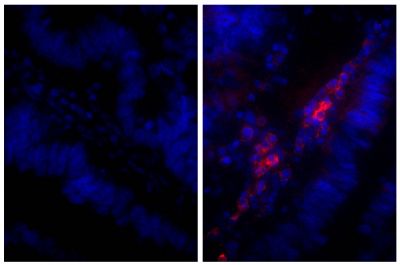 Paraffin embedded human gastric cancer tissue was stained with Rabbit IgG-UNLB isotype control (SB Cat. No. 0111-01; left) and Rabbit Anti-Human IgG(H+L), Mouse ads-UNLB (SB Cat. No. 6145-01; right) followed by Donkey Anti-Rabbit IgG(H+L), Mouse/Rat/Human SP ads-AF555 (SB Cat. No. 6440-32) and DAPI.