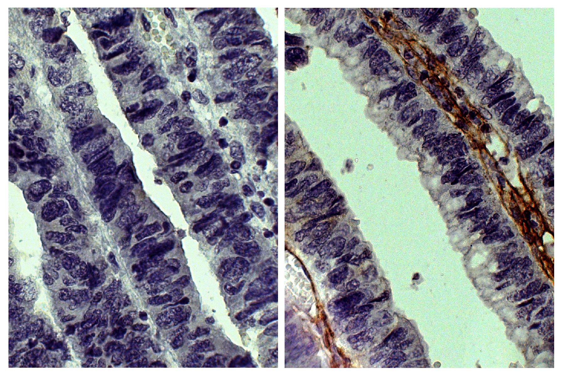 Paraffin embedded human gastric cancer tissue was stained with Goat IgG-UNLB isotype control (SB Cat. No. 0109-01; left) and Goat Anti-Type III Collagen-UNLB (SB Cat. No. 1330-01; right) followed by Swine Anti-Goat IgG(H+L), Human/Rat/Mouse SP ads-HRP (SB Cat. No. 6300-05), DAB, and hematoxylin.
