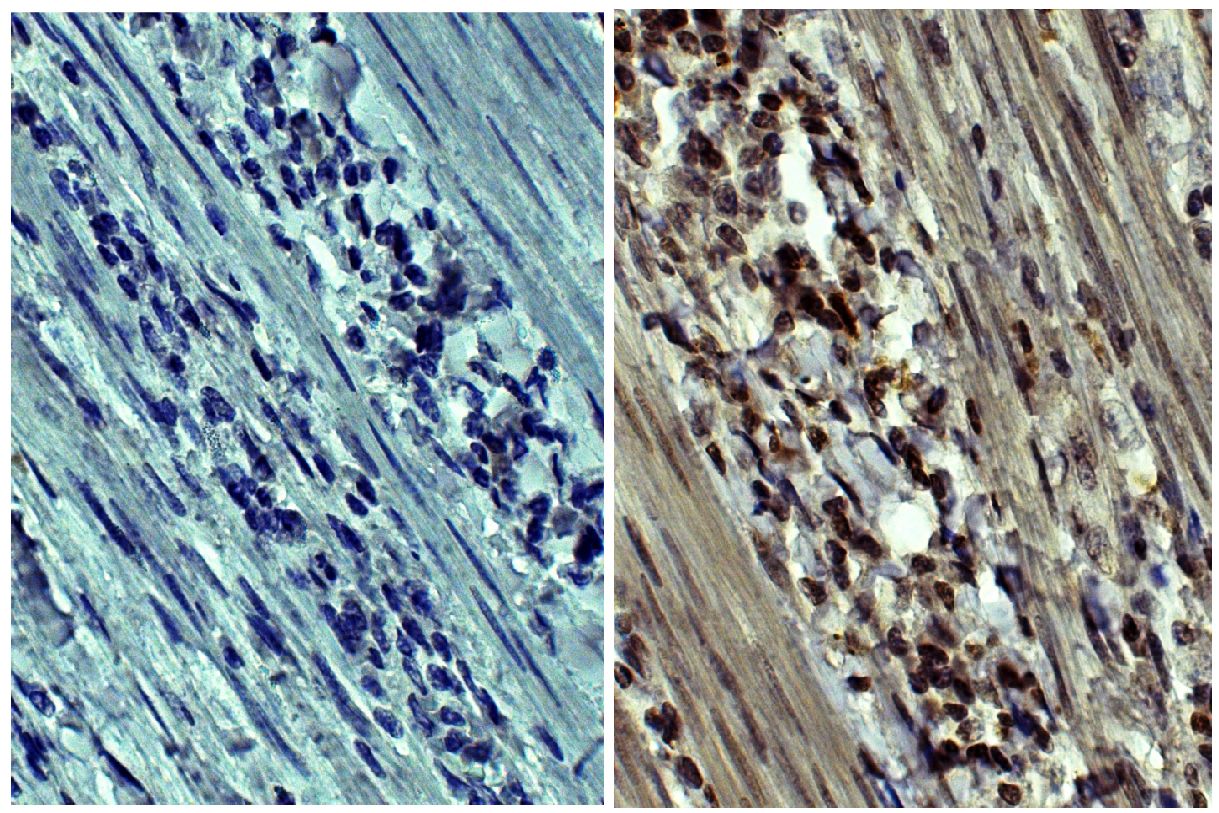 Paraffin embedded human gastric cancer tissue was stained with Mouse IgG<sub>2a</sub>-HRP isotype control (SB Cat. No. 0103-05; left) and Mouse Anti-Human MMP-9-HRP (SB Cat. No. 12025-05; right).