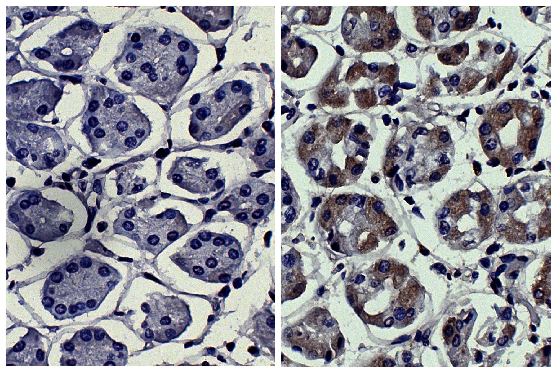 Paraffin embedded human kidney cancer tissue was stained with Mouse IgG<sub>2a</sub>-UNLB isotype control (SB Cat. No. 0103-01; left) and Mouse Anti-Human MMP-3-UNLB (SB Cat. No. 12020-01; right) followed by Goat Anti-Mouse IgG<sub>2a</sub>, Human ads-HRP (SB Cat. No. 1080-05), DAB, and hematoxylin.