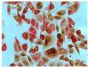 Human pancreatic carcinoma cell line MIA PaCa-2 was stained with Mouse Anti-Cytokeratin 8-UNLB (SB Cat. No. 10080-01; IgG<sub>2a</sub>) and Mouse Anti-Human MMP-1-UNLB (SB Cat. No. 12011-01; IgG<sub>2b</sub>) followed by Goat Anti-Mouse IgG<sub>2a</sub>, Human ads-AP (SB Cat. No. 1080-04) and Goat Anti-Mouse IgG<sub>2b</sub>, Human ads-HRP (SB Cat. No. 1090-05), Red AP, DAB, and mounted with Fluoromount-G<sup>&reg;</sup> (SB Cat. No. 0100-01).
