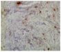 Frozen chicken ovarian tumor section was stained with Mouse Anti-Chicken CD8α-UNLB (SB Cat. No. 8220-01) followed by an HRP conjugated secondary antibody, DAB, and hematoxylin.<br/>Image from Bradaric MJ, Barua A, Penumatsa K, Yi Y, Edassery SL, Sharma S, et al. Sphingosine-1 phosphate receptor (S1p1), a critical receptor controlling human lymphocyte trafficking, is expressed in hen and human ovaries and ovarian tumors. J Ovarian Res. 2011;4:4. Figure 7(d)<br/>Reproduced under the Creative Commons license https://creativecommons.org/licenses/by/2.0/