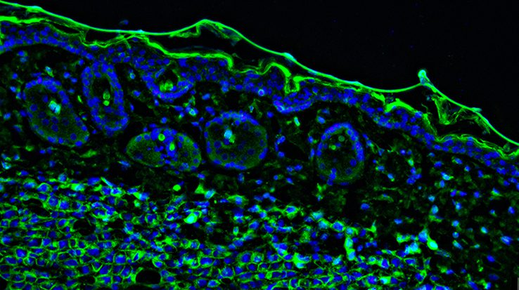 Tumour immunofluorescence IHC image. Aggressive metastatic Melanoma Tumor cells in green with blue nuclei invading into the skin.